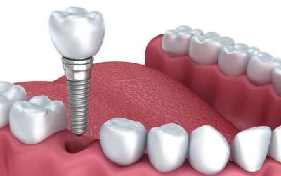 Dental Implants