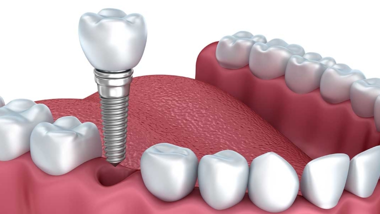 Dental Implants